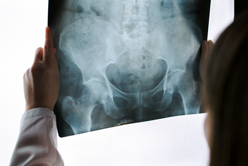 Что показывает рентген тазобедренного сустава?