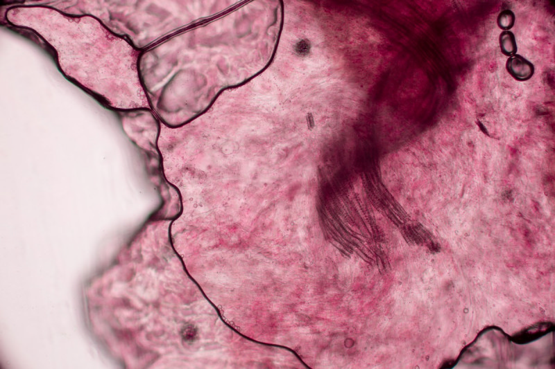 Что такое спондилоартроз — 1