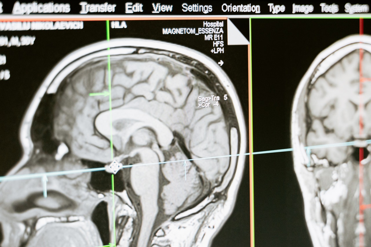 Компьютерная томография (КТ) головного мозга