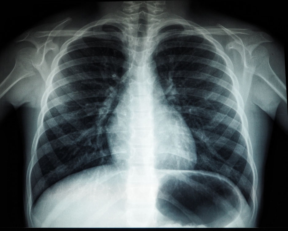 Как проходит рентгенография грудной клетки