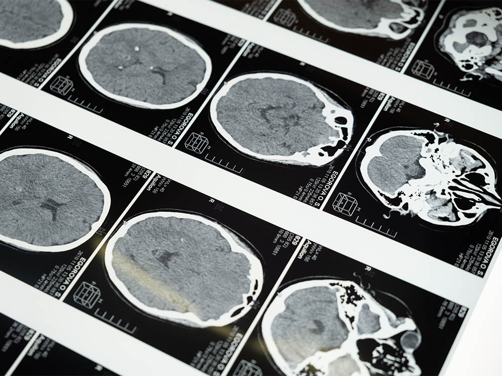 Как проходит МРТ контрастное МРТ мозга