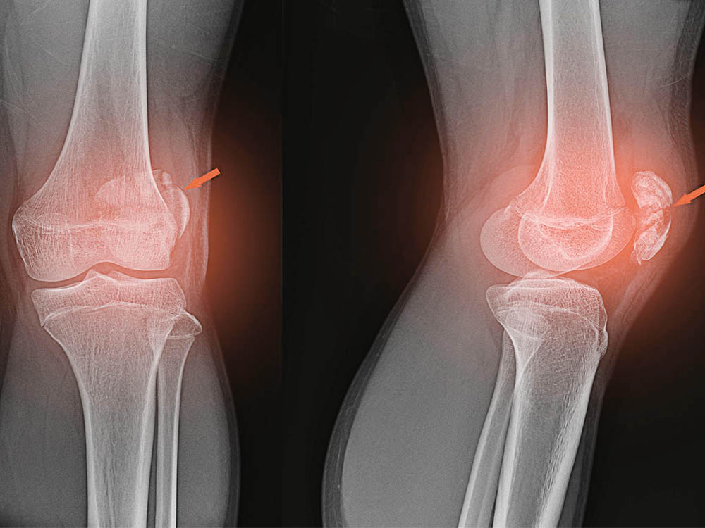 Подготовка к рентгену суставов коленей