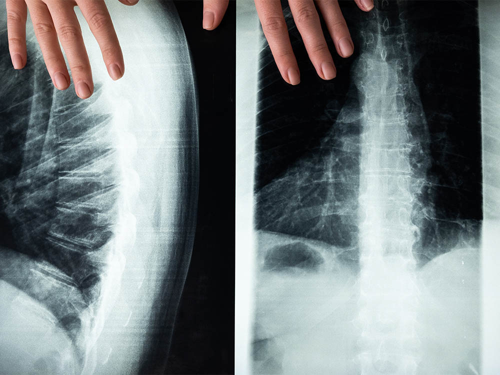 Как проходит рентгенография спины