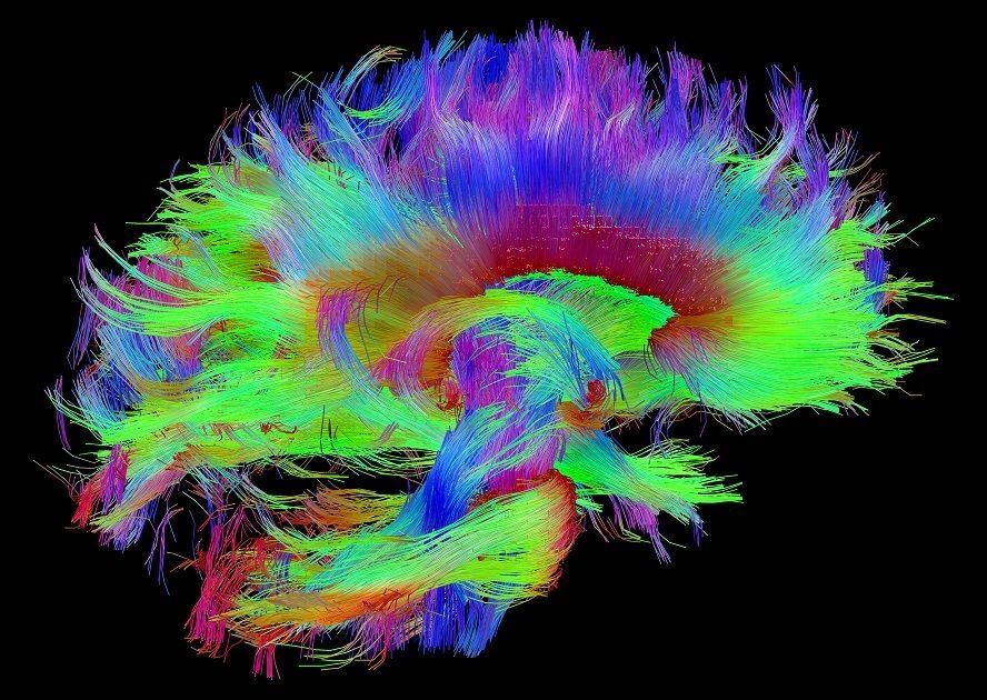 МРТ перфузия головного мозга