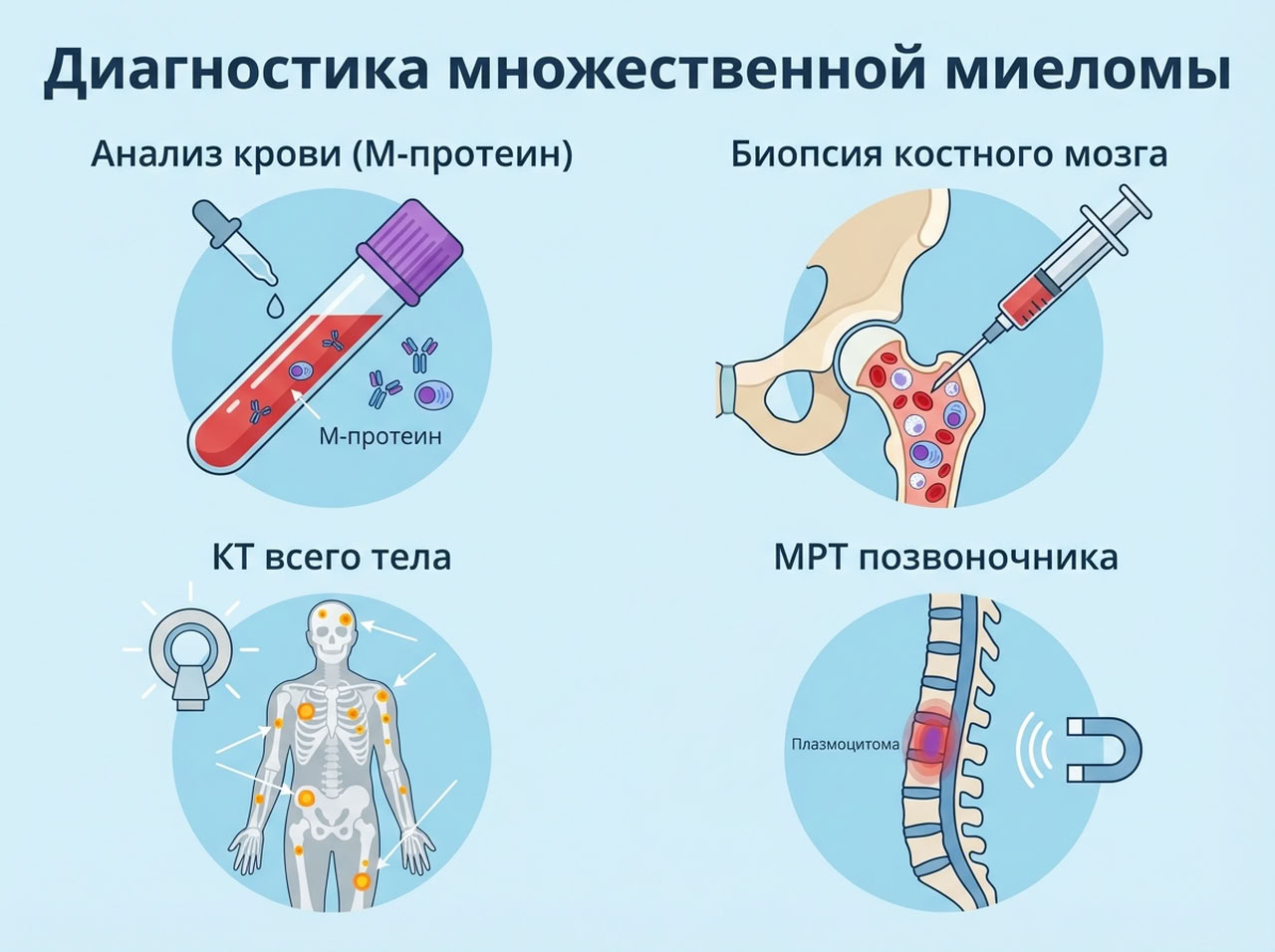 Множественная миелома — 3