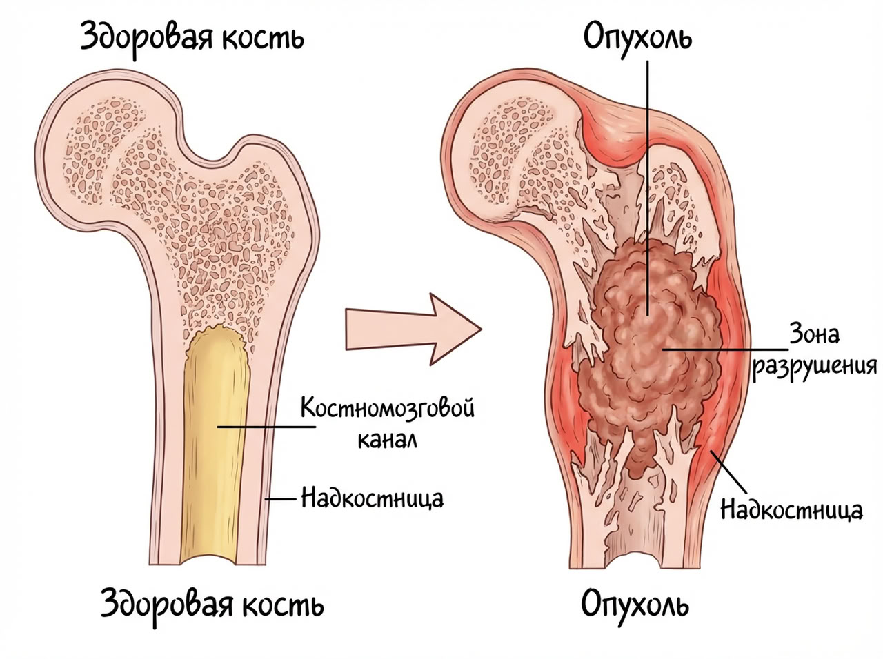 Опухоли костей и хрящей — 1