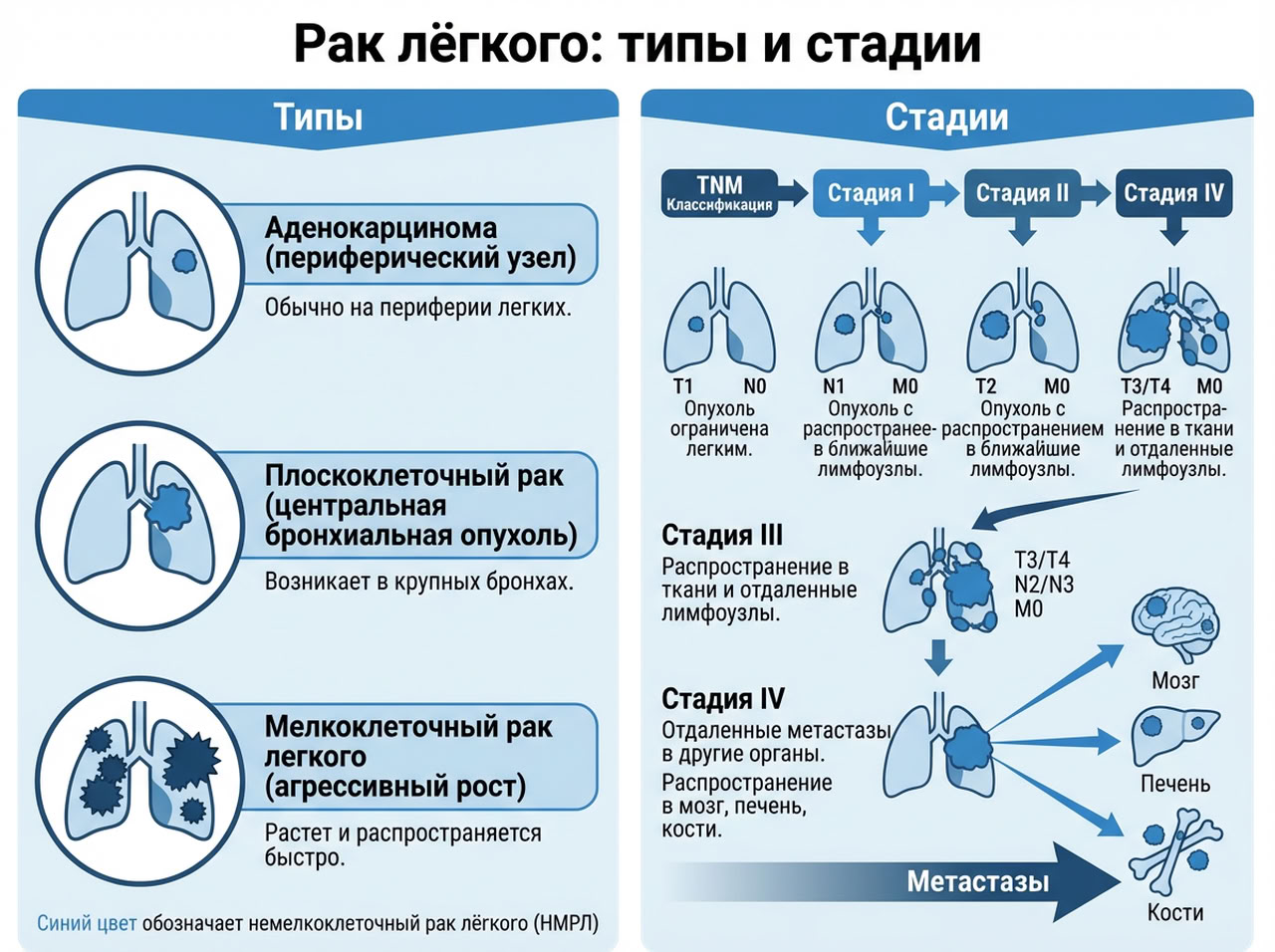 Рак легкого — 2