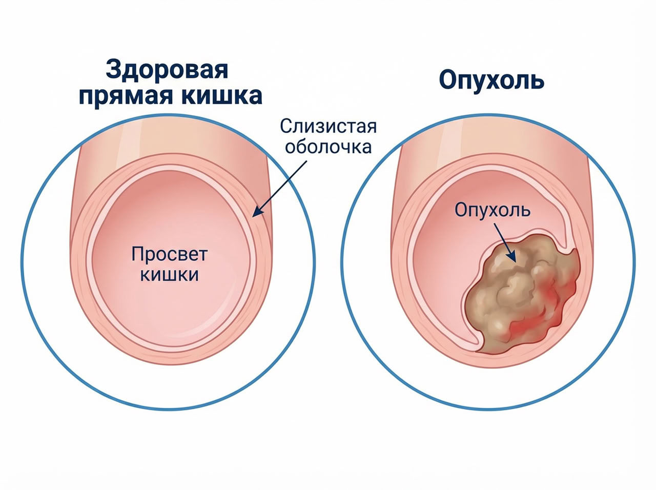 Рак прямой кишки — 1