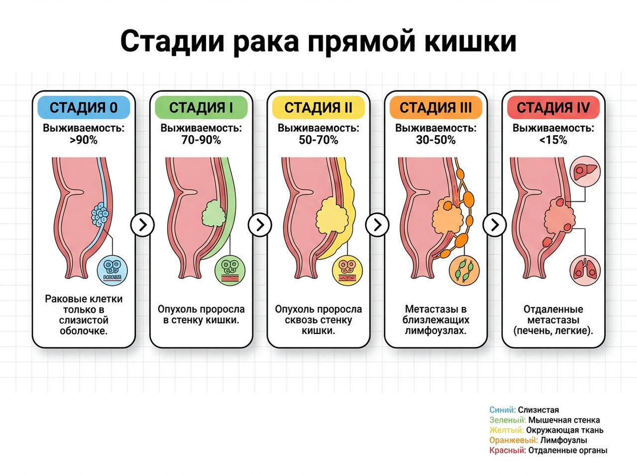 Рак прямой кишки — 2