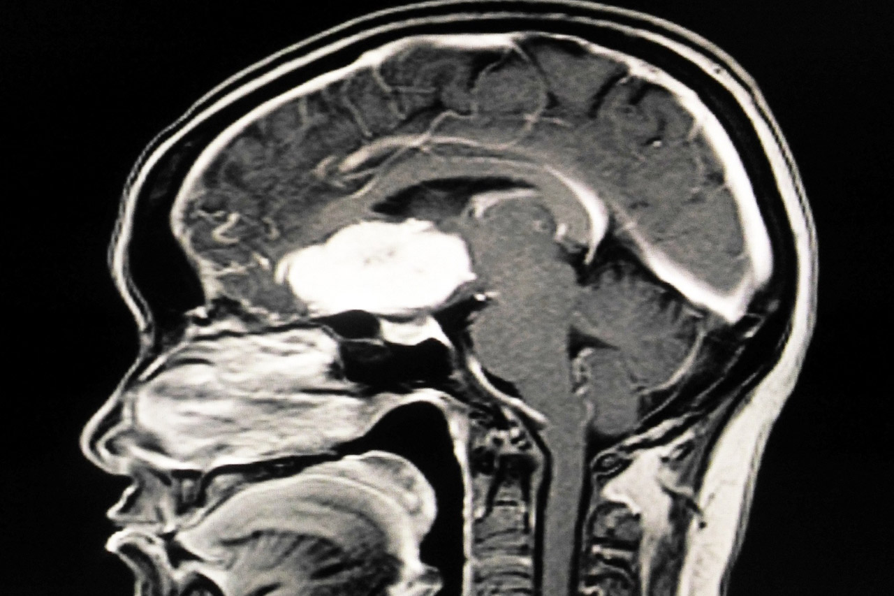 Как проходит КТ головного мозга с контрастом